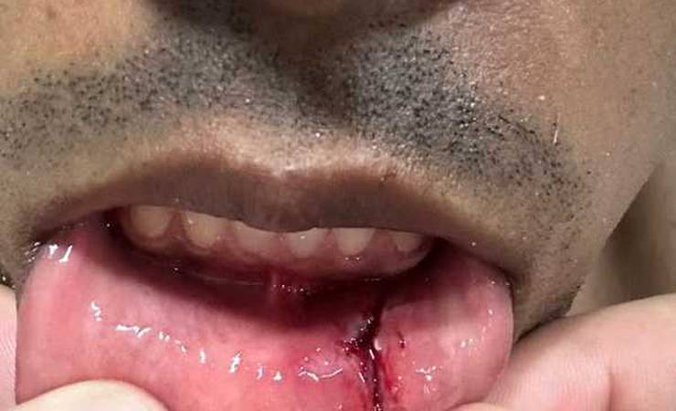 Bruno Henrique posta foto de corte na boca sofrido em lance de pênalti para o Flamengo